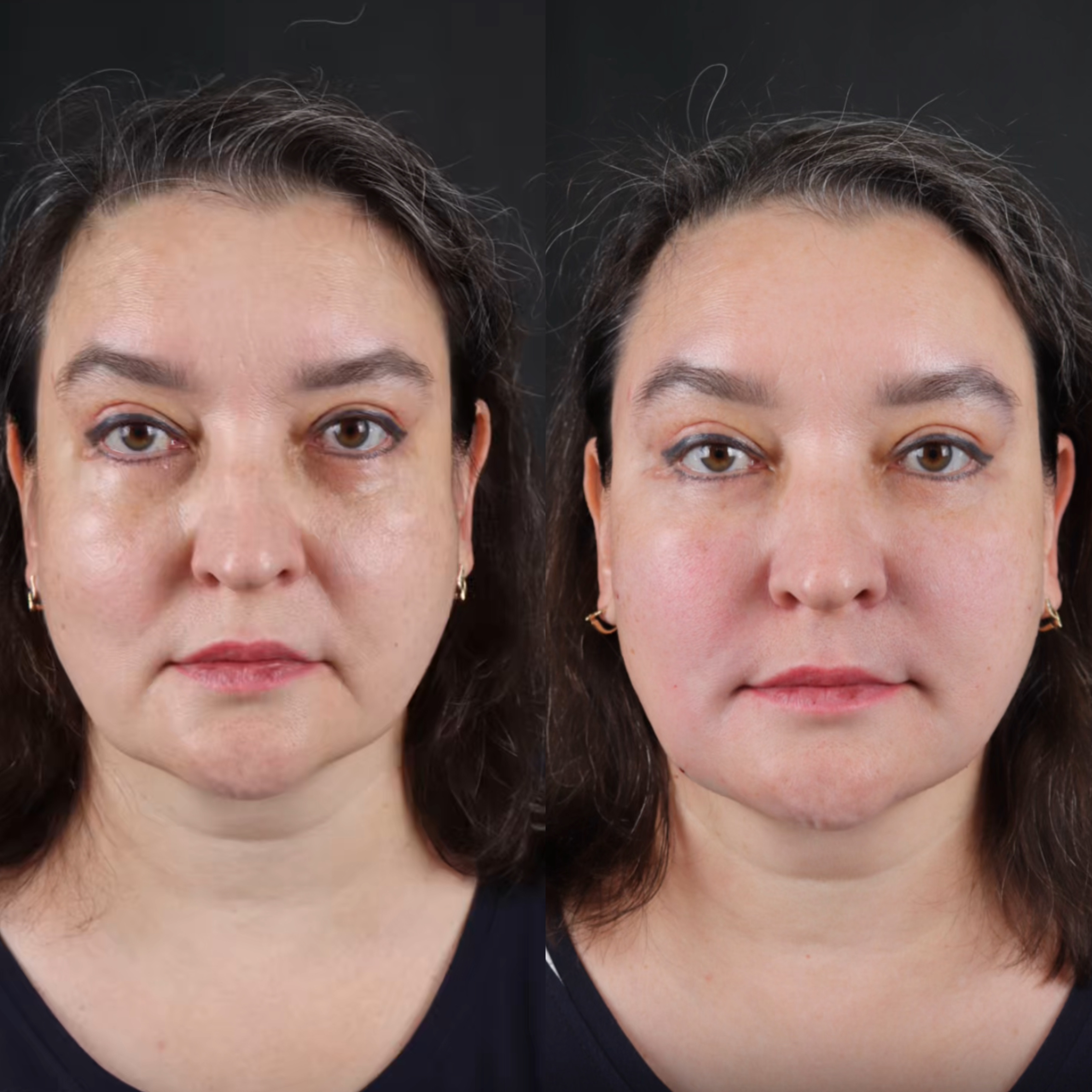 Нано Фет Графтинг — естественное и безопасное омоложение